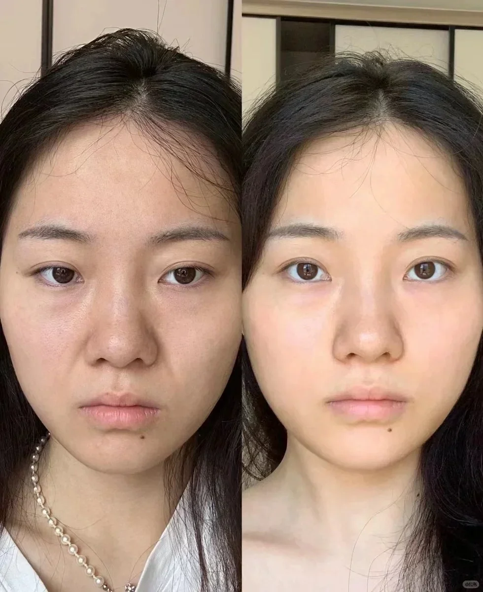 本人认为恢复面部平整最屌的运动