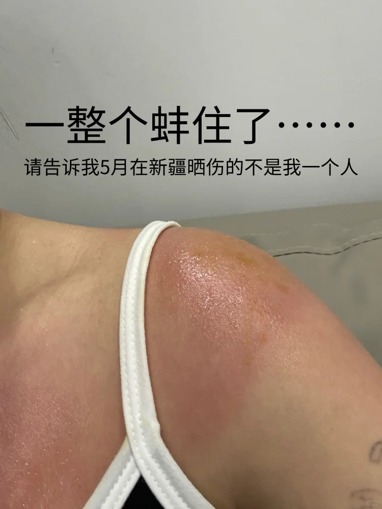 血泪教训｜5月在新疆能晒成这样我也是服了