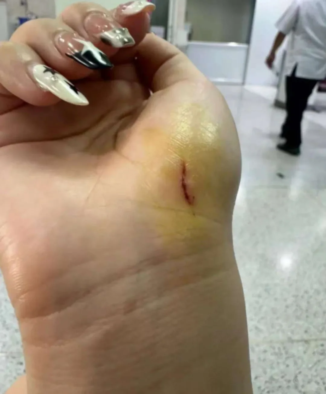 出国玩不小心受伤，打破伤风针急救攻略