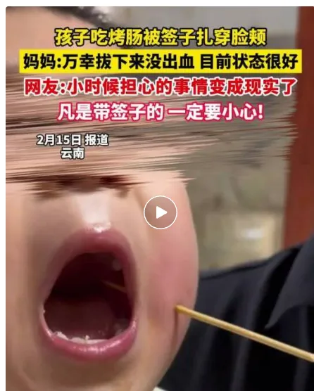 男孩在云南一景区吃烤肠时被签子扎穿脸颊