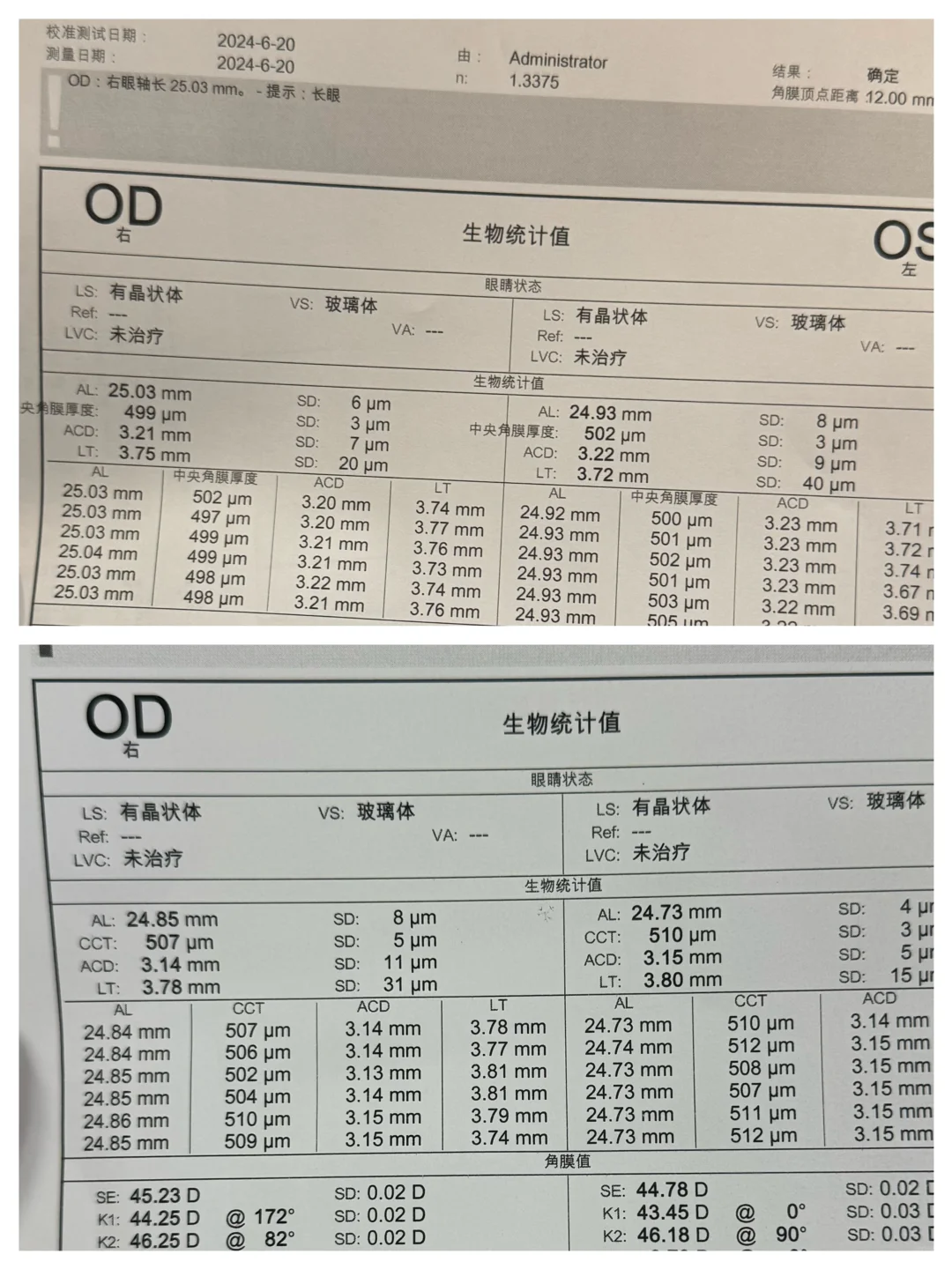 一千度高度近视退度数退轴啦！！！