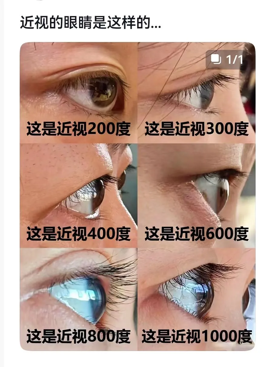 ??不同度数眼睛的变化!