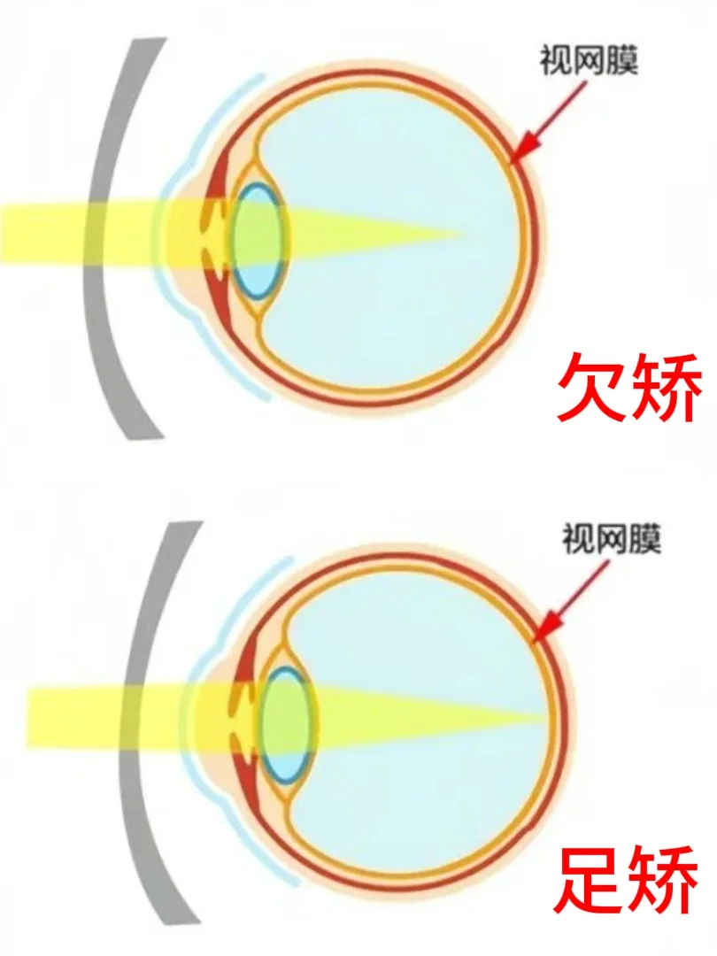 配眼镜度数配足，真的好吗？