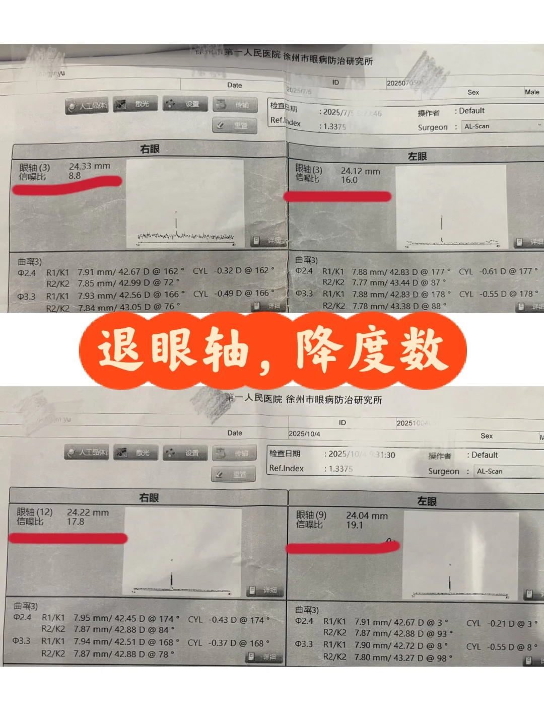 近视度数居然真的降了！眼轴也退了！