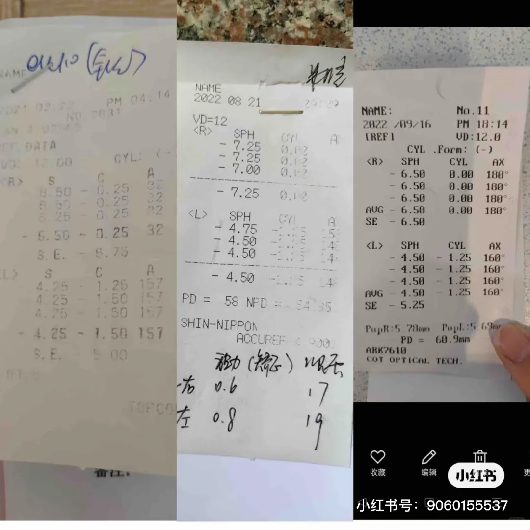 本人亲测，近视度数就是可降的（左眼-50°）