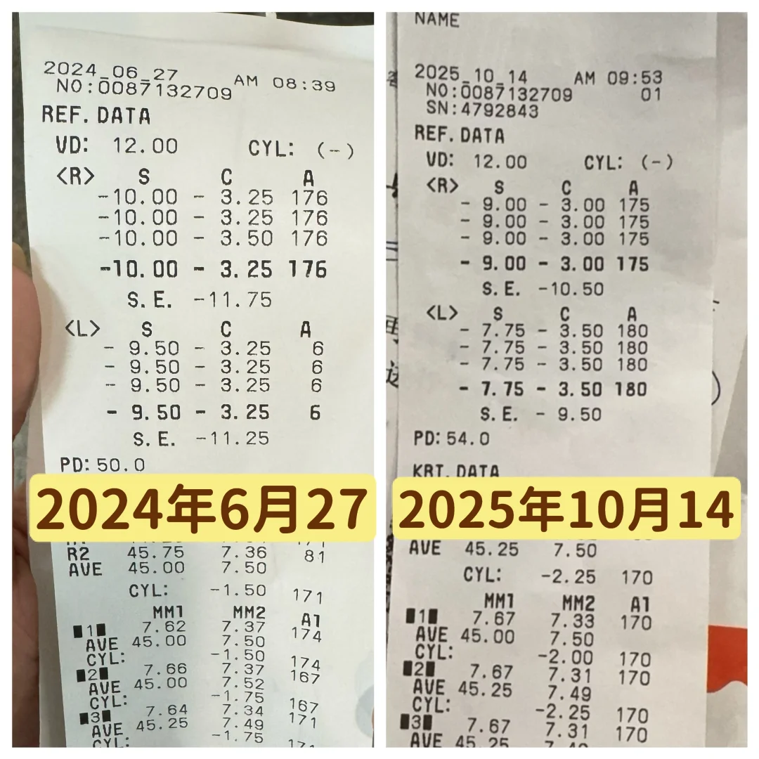 一千度高度近视退度数退轴啦！！！