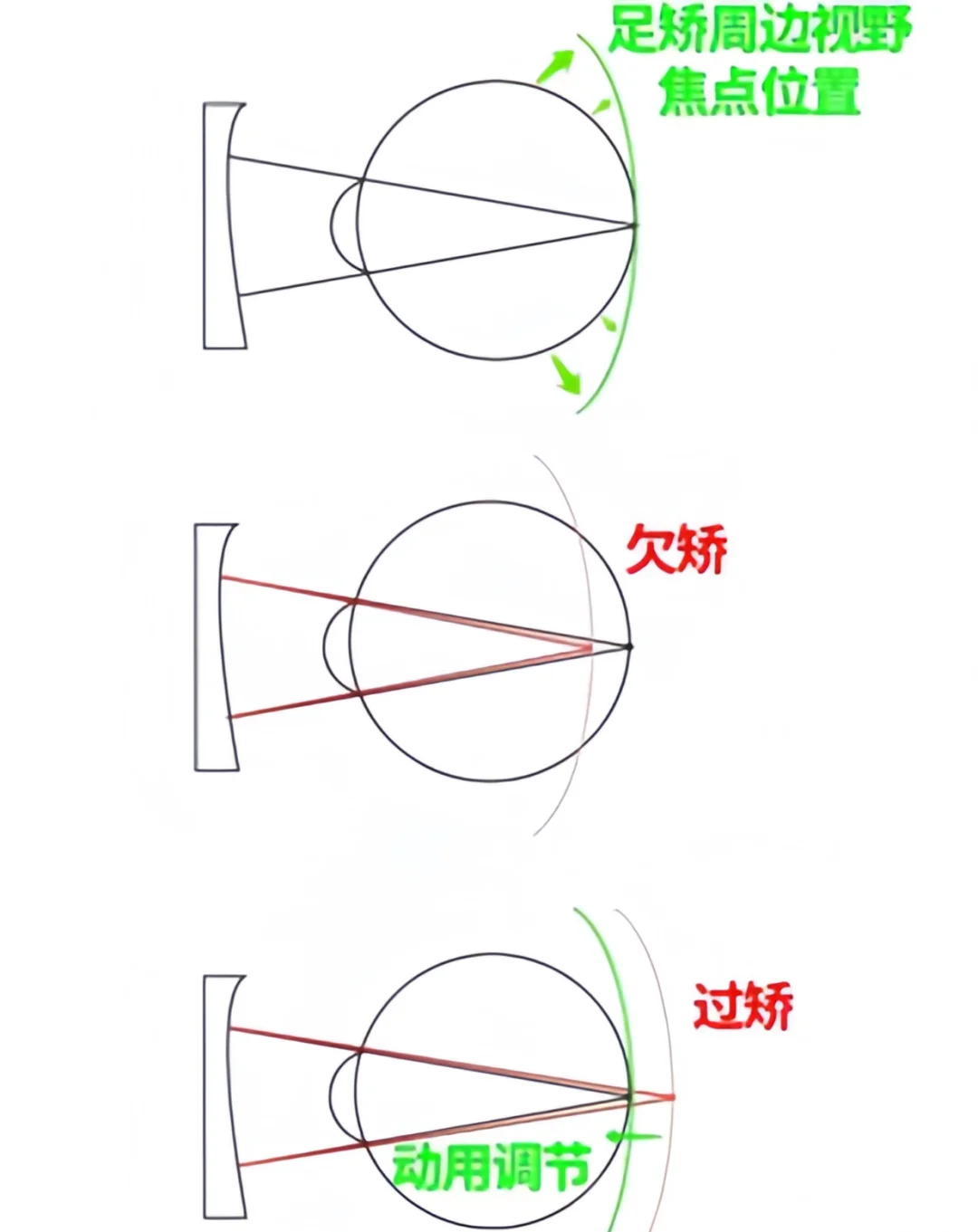 配眼镜度数配足，真的好吗？