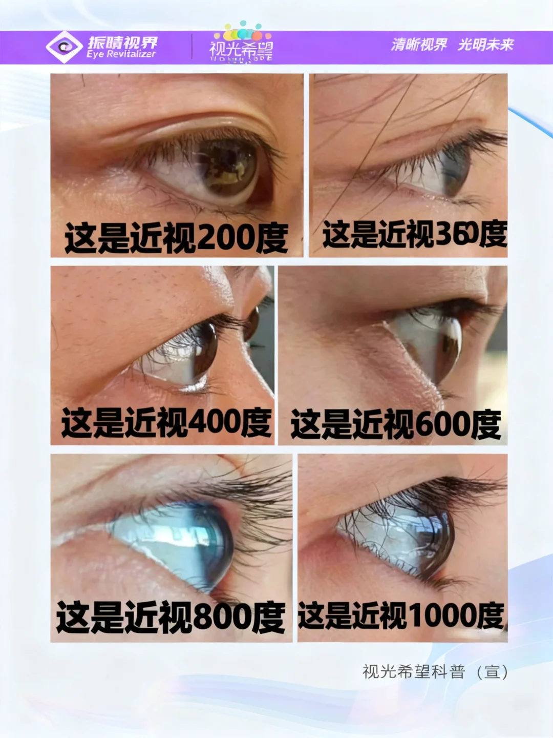 近视度数肉眼直击！1000度眼轴看过吗？