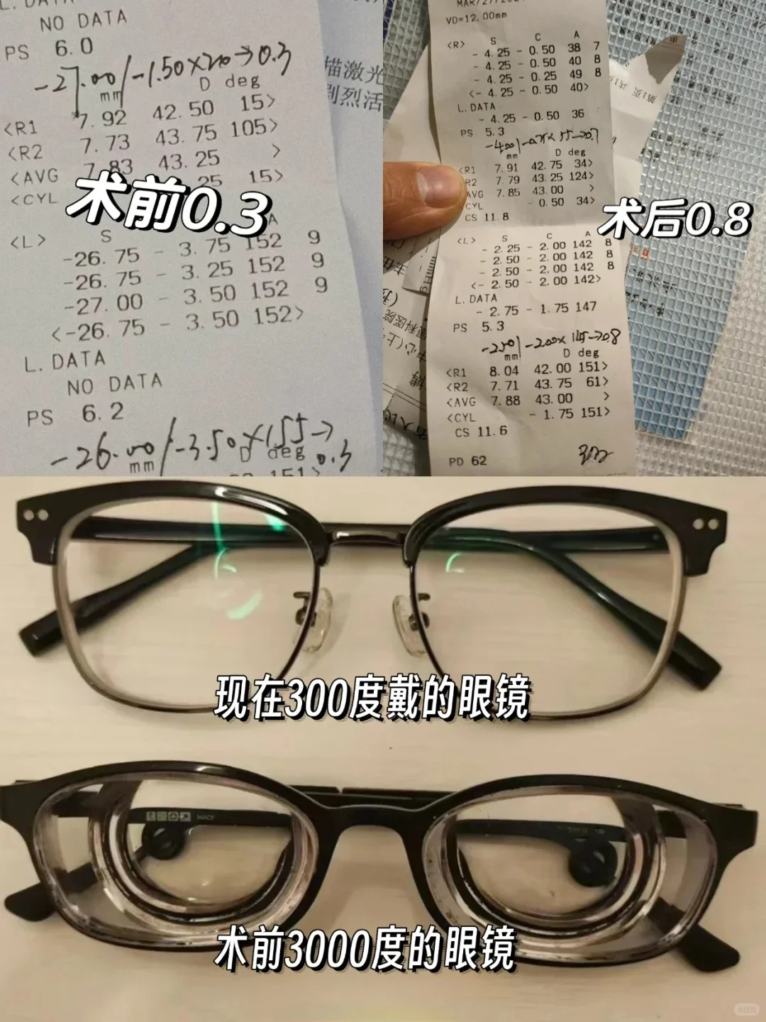 3500度到300度，为了护眼我对自己有多狠