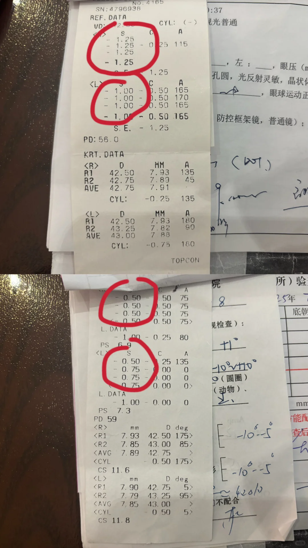 近视度数居然真的降了！眼轴也退了！