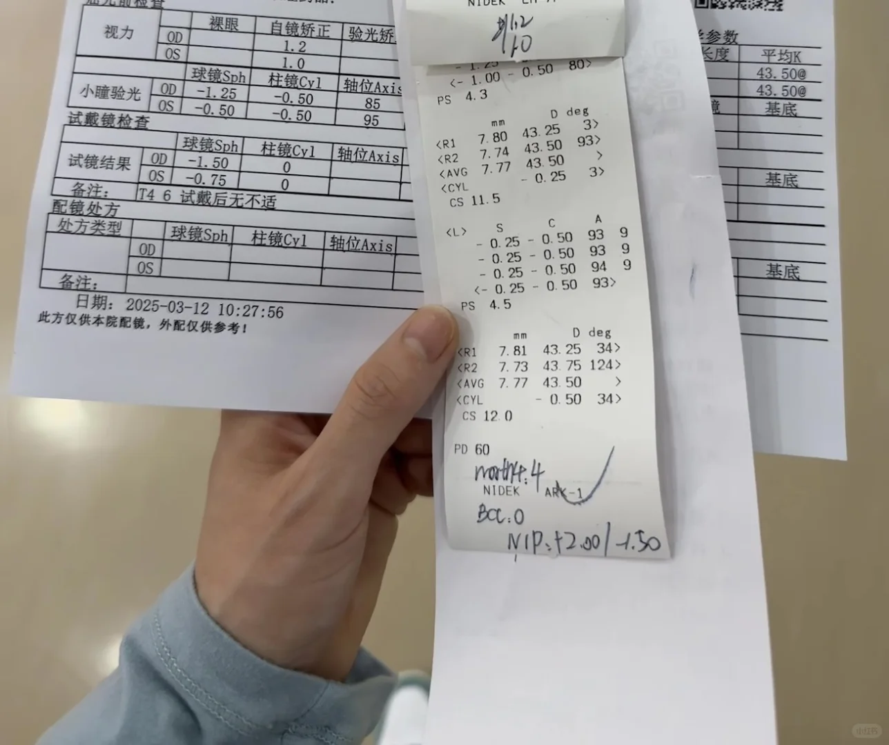 300多度近视直线下降到好了？后续度数确定！！