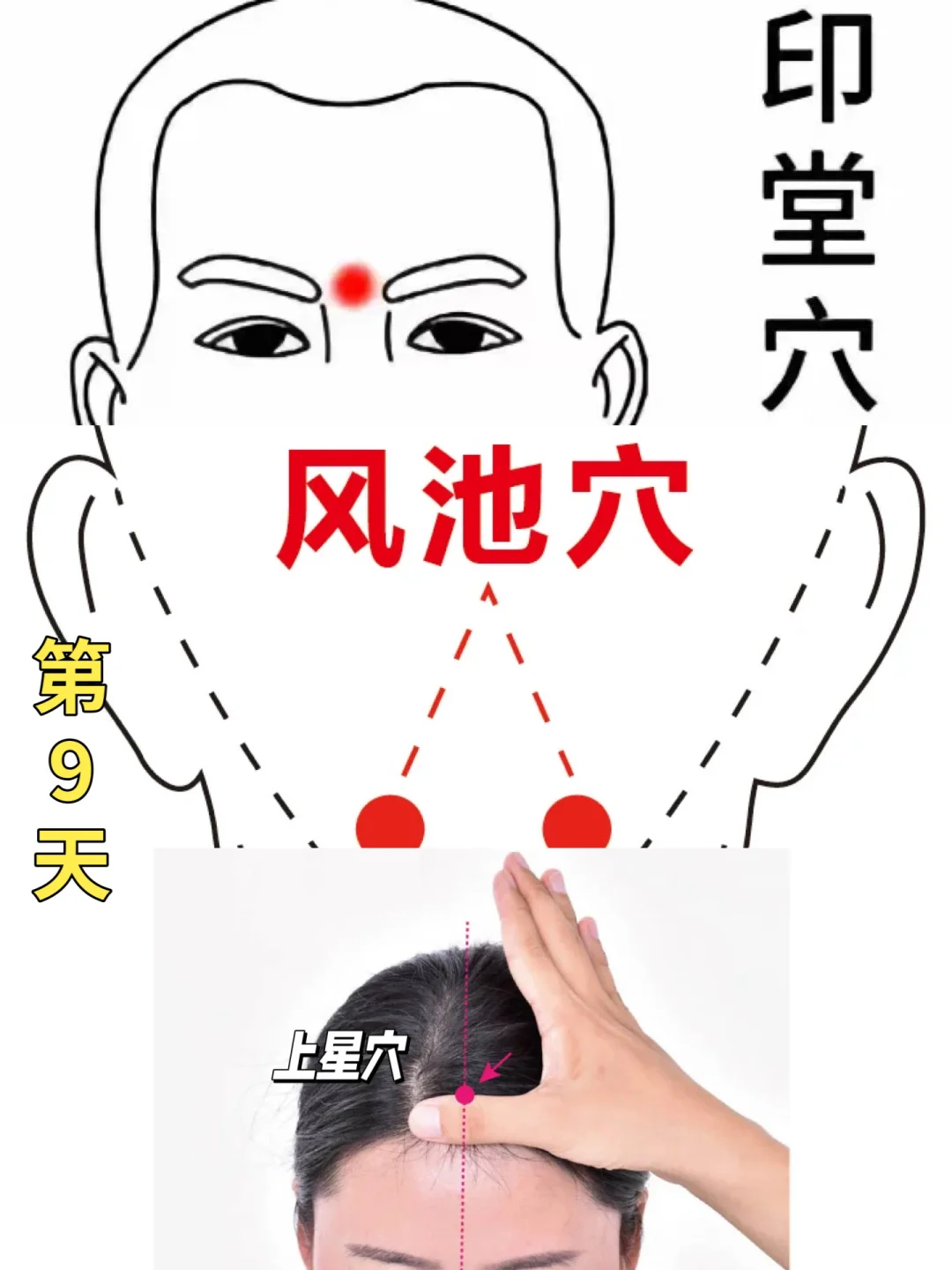 艾灸两个月近视散光！！