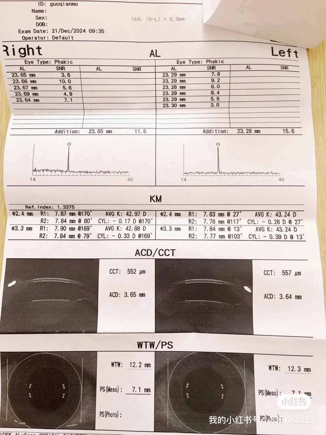 近视度数的计算方法