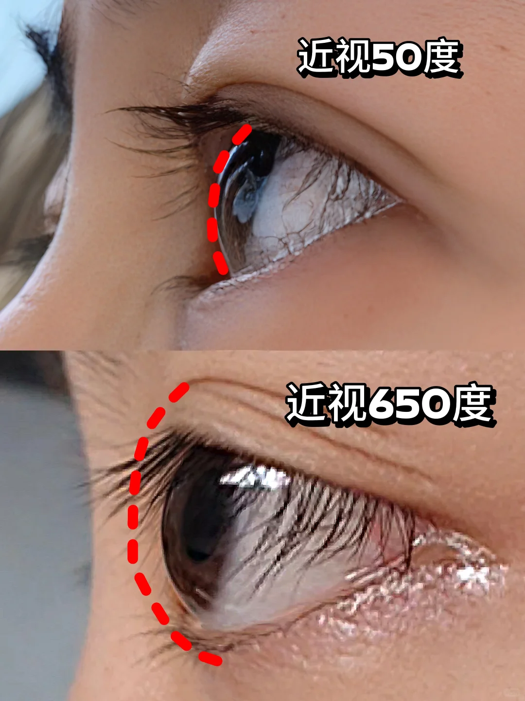 高度近视真的会