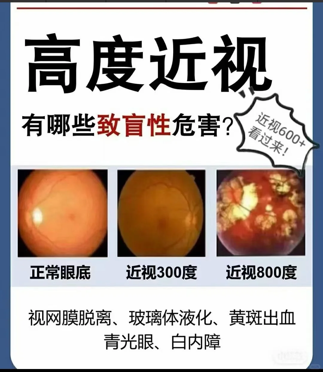 高度近视真的会致盲吗？