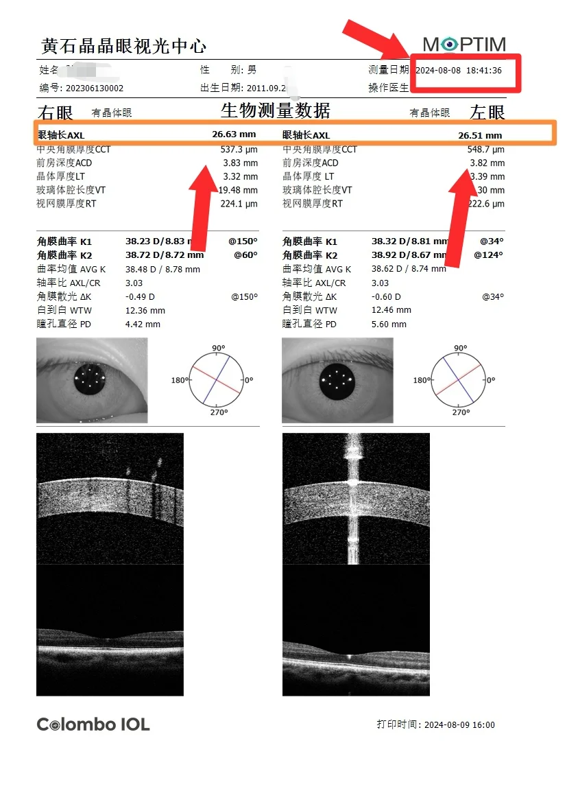 一张图看懂生物测量仪、电脑验光单！