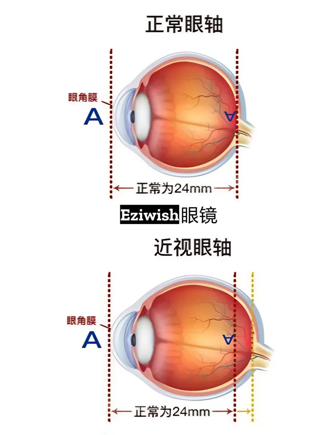 高度近视真的会