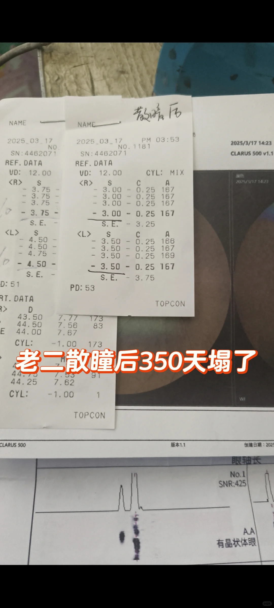 五个多月配镜375/325到150/125