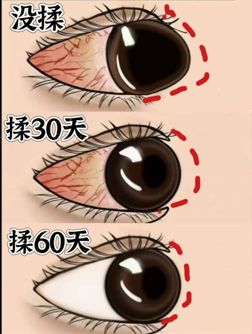 高度近視,揉开这里才是关键!!!~