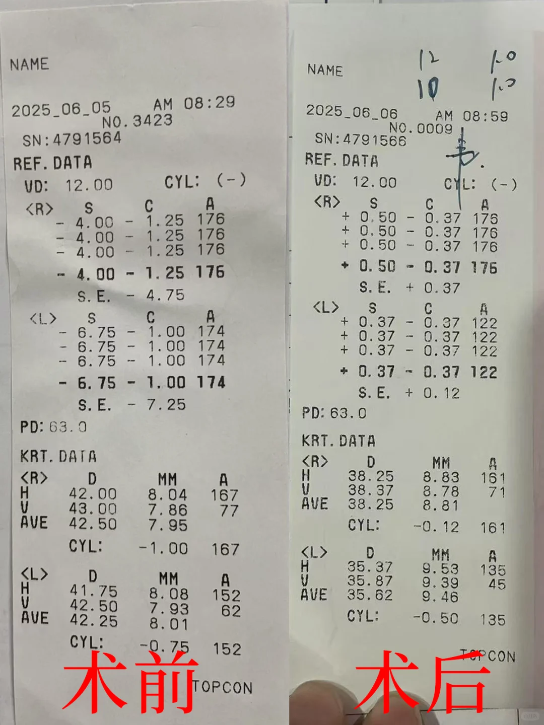 近视手术前后的验光单对比