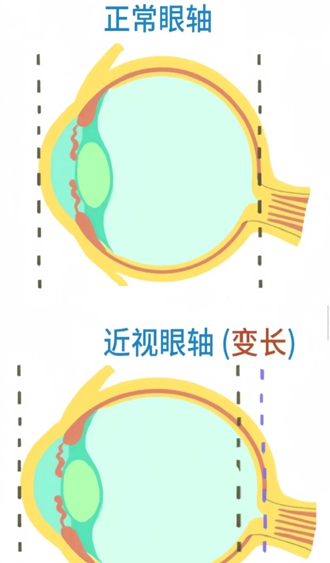 了解近视的原理，才知道怎么预防