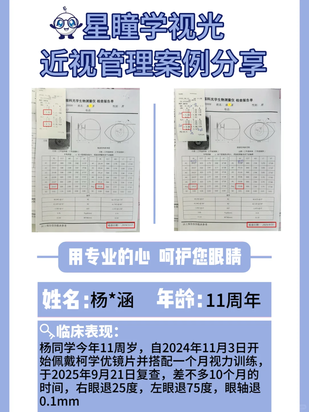 9-11岁近视的孩子，怎么退轴退度数？