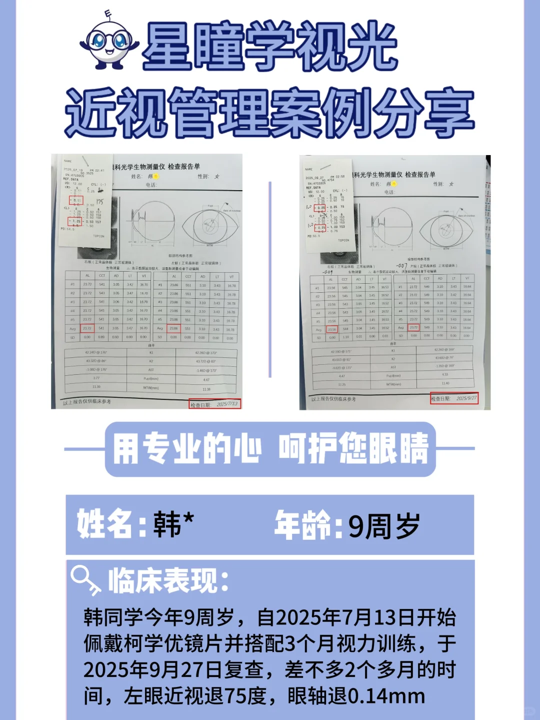 9-11岁近视的孩子，怎么退轴退度数？