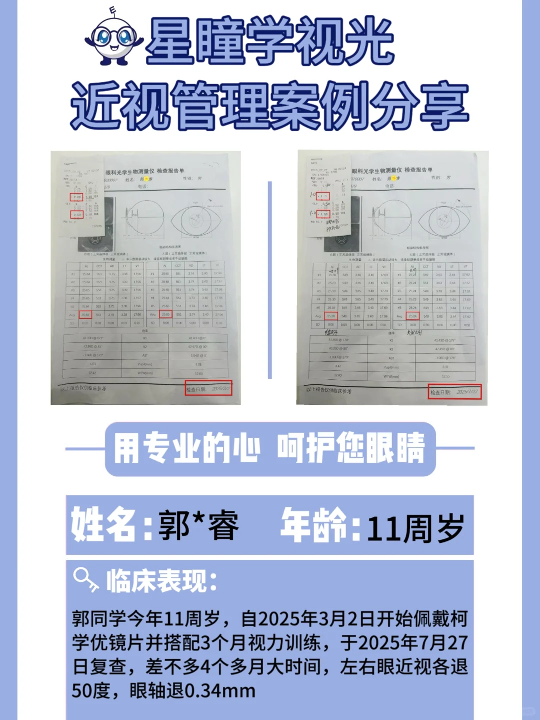 9-11岁近视的孩子，怎么退轴退度数？