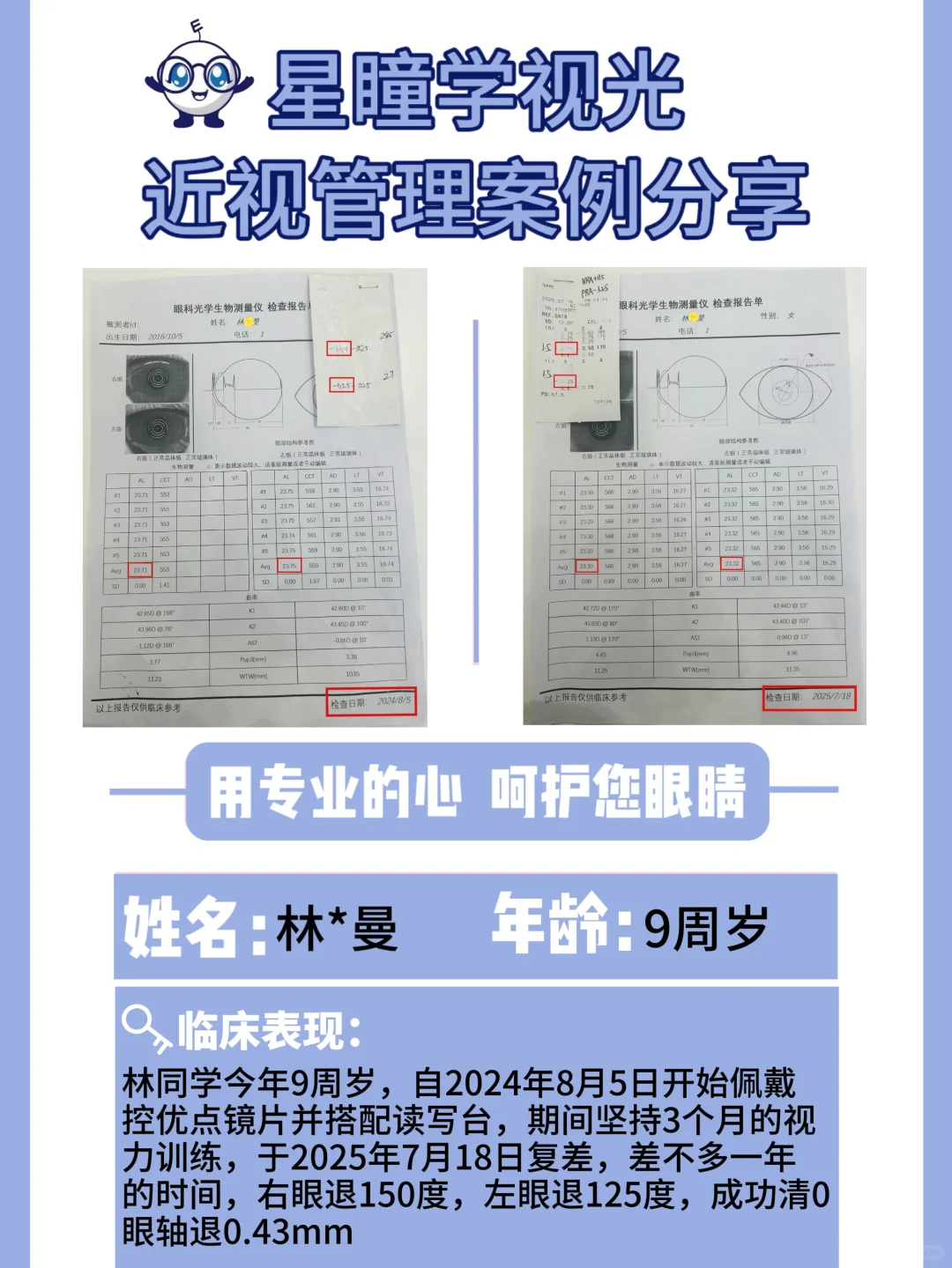 9-11岁近视的孩子，怎么退轴退度数？