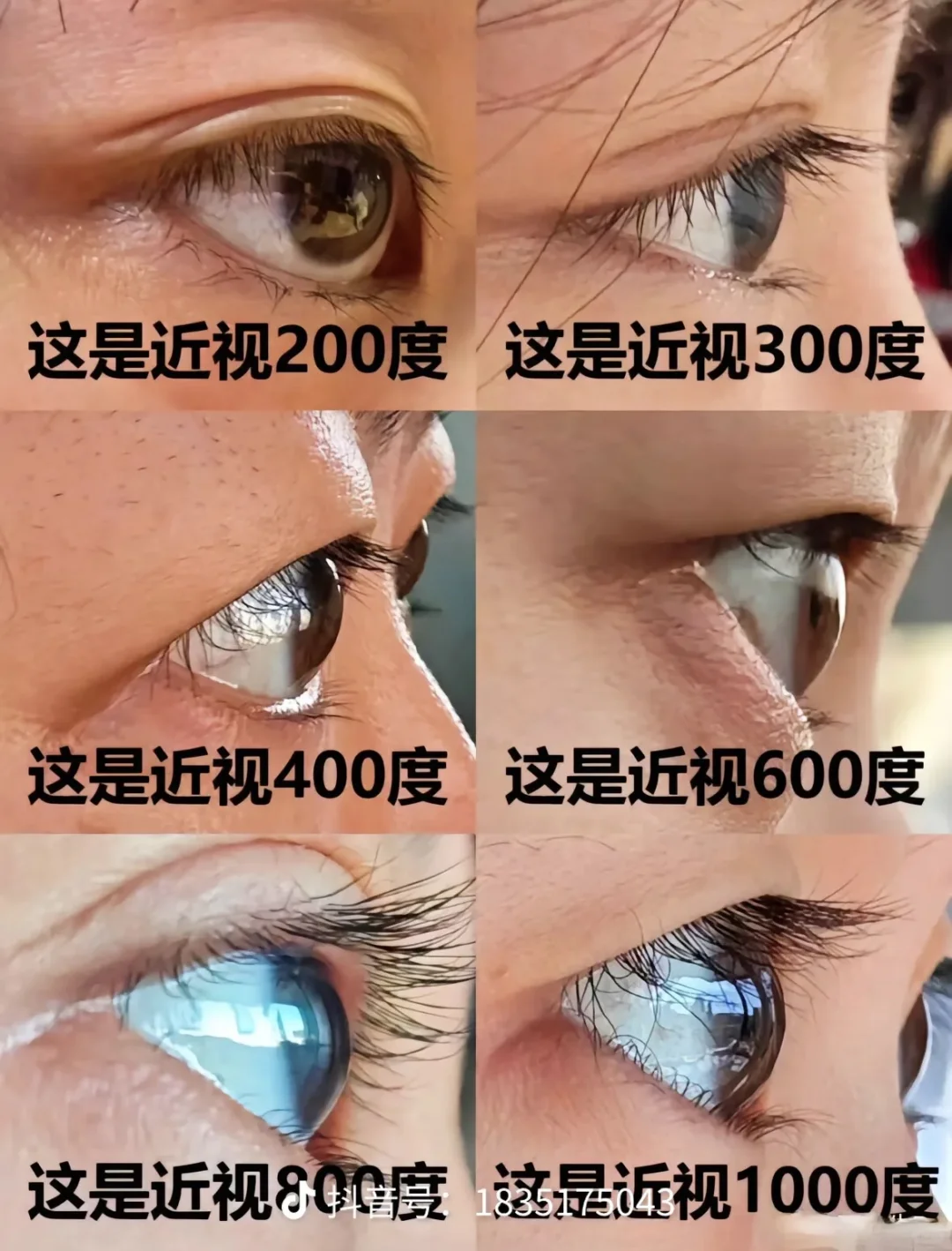 一镜看懂近视度数的奥秘