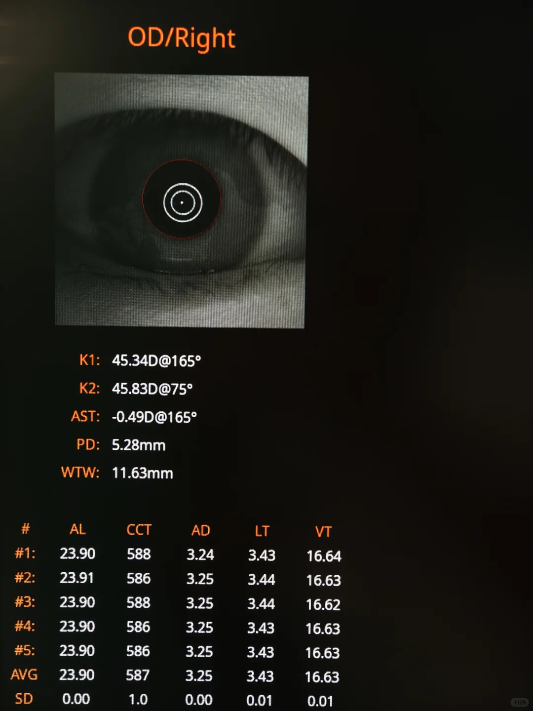孩子眼轴长了，为何度数没长？