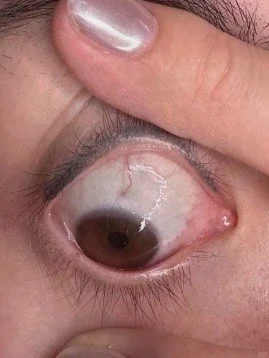 5oo多度 晒太阳远近交替一年半的结果