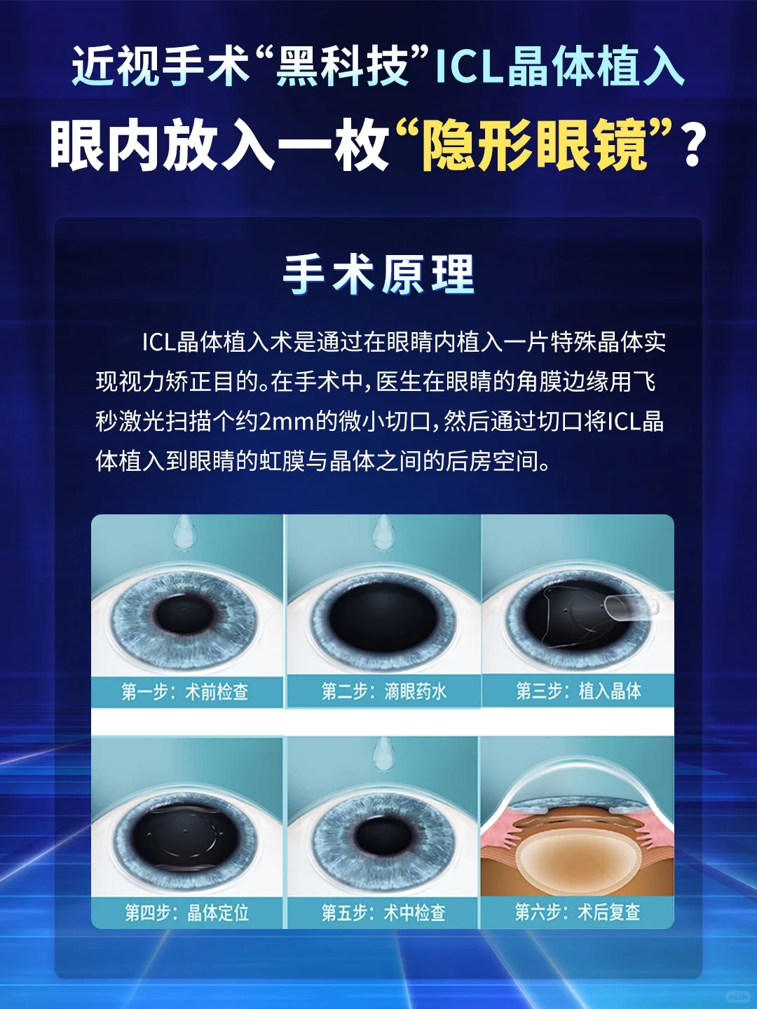 角膜薄、度数高？ICL晶体植入术直接冲！