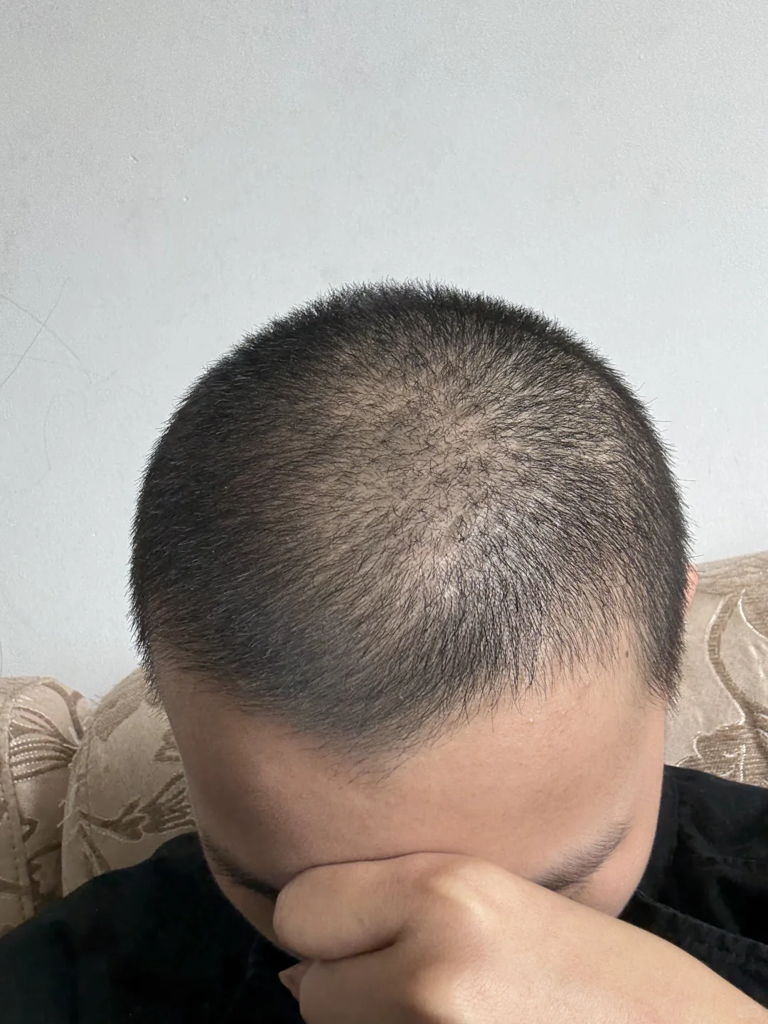 第二次光头蓄发第23天