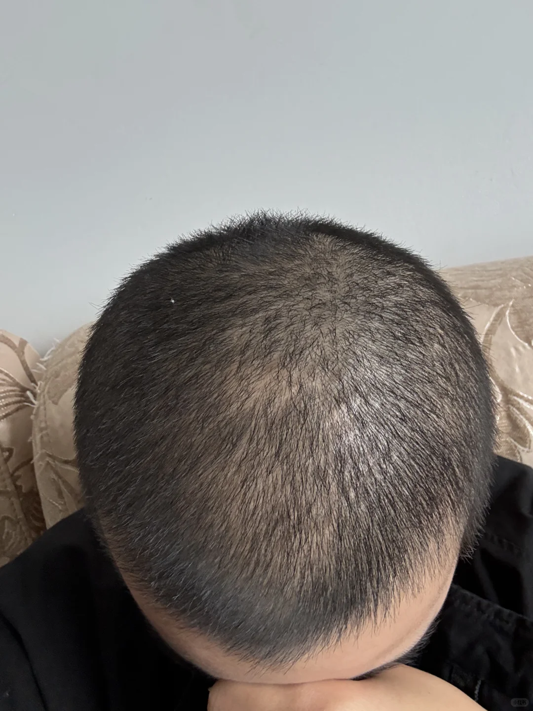 第二次光头蓄发第23天