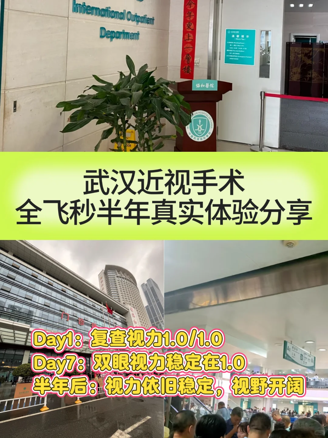 武汉近视手术，全飞秒半年真实体验分享