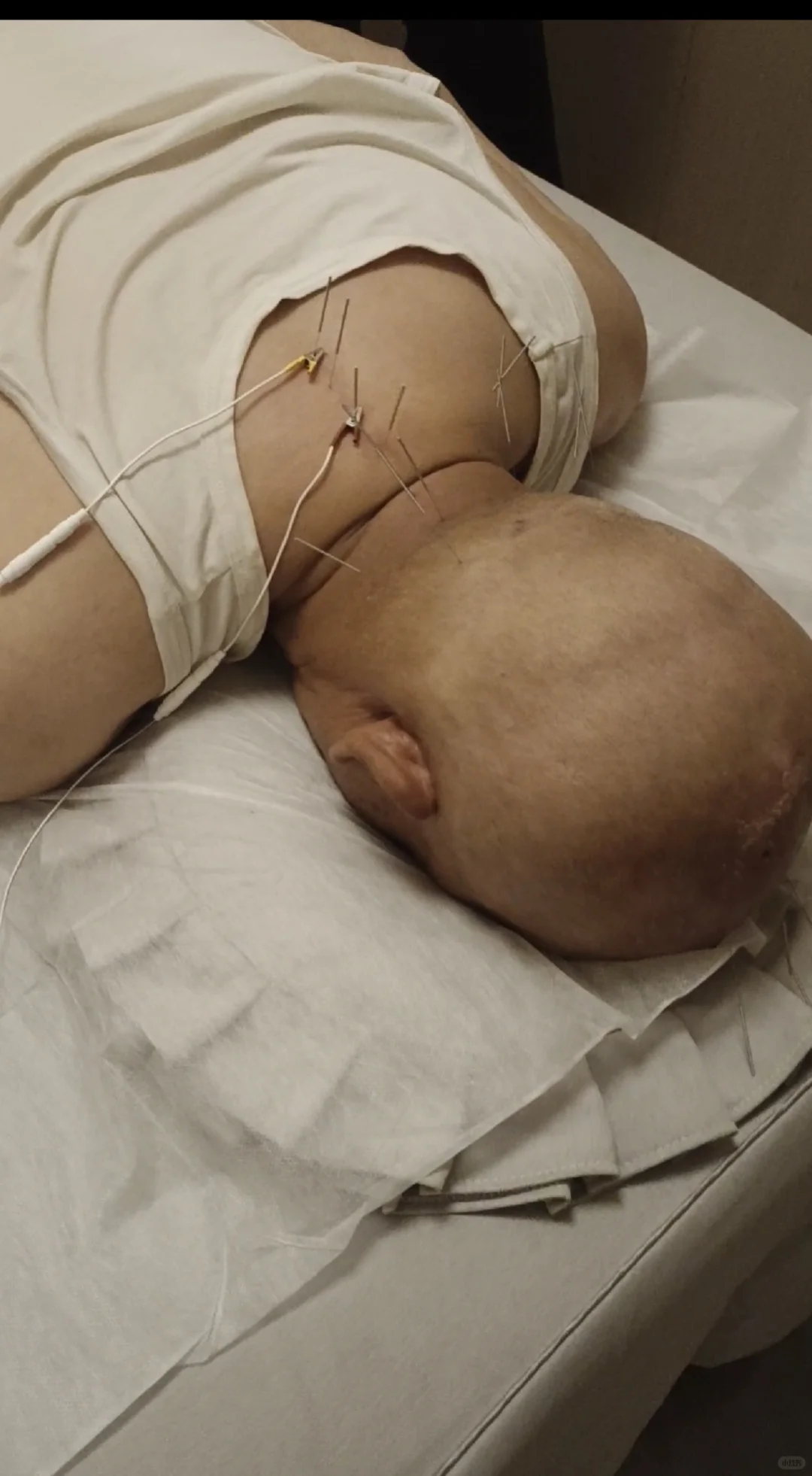 老爸脑梗治疗后在家锻炼的日子