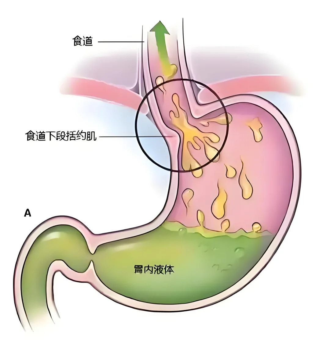胃食管反流，消化内镜快速修复！