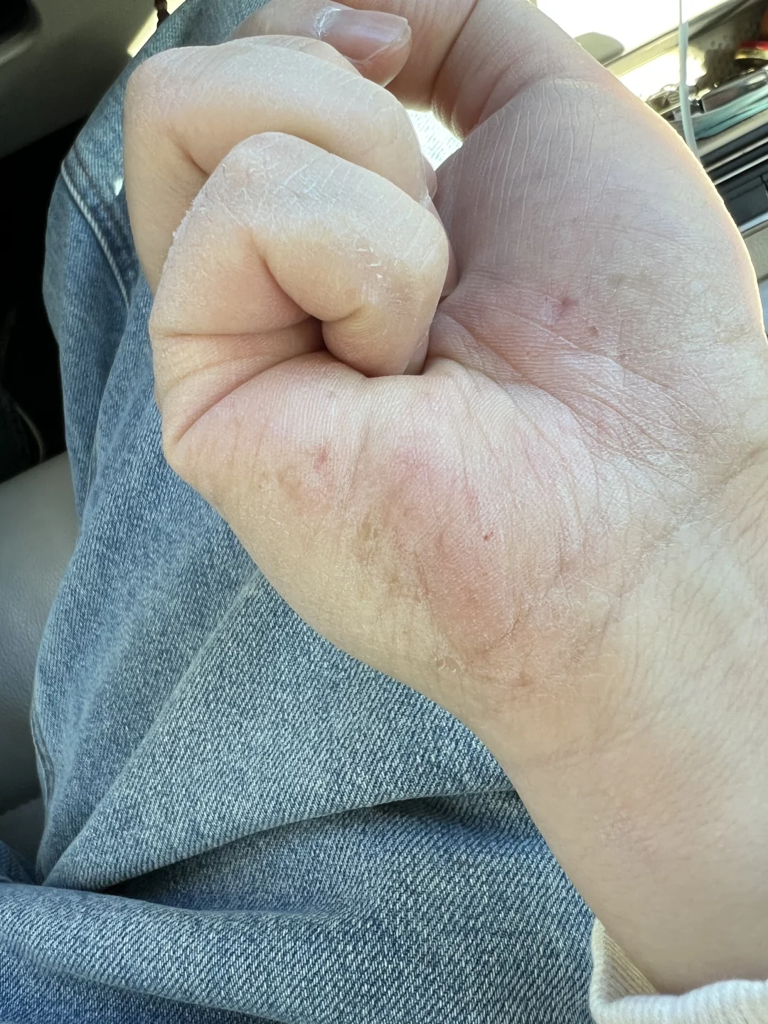 破相拯救篇，微压氧舱助力