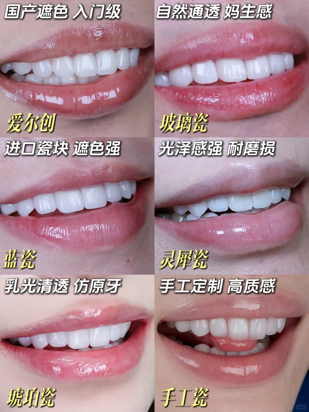 牙贴面｜一篇看懂不同价位贴面优缺点