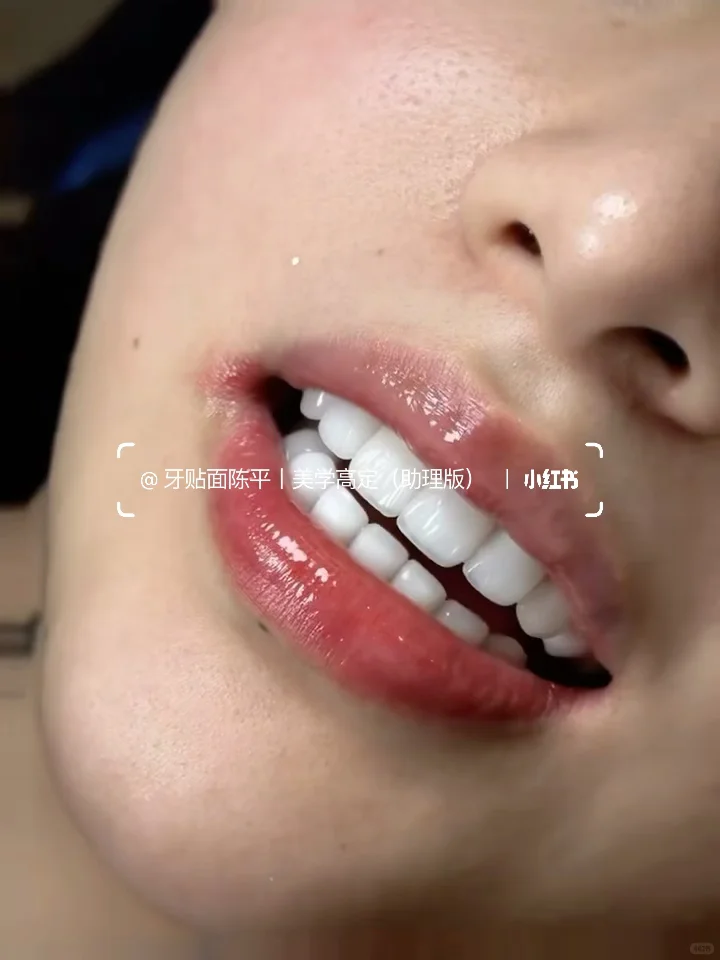 牙贴面｜一篇看懂不同价位贴面优缺点