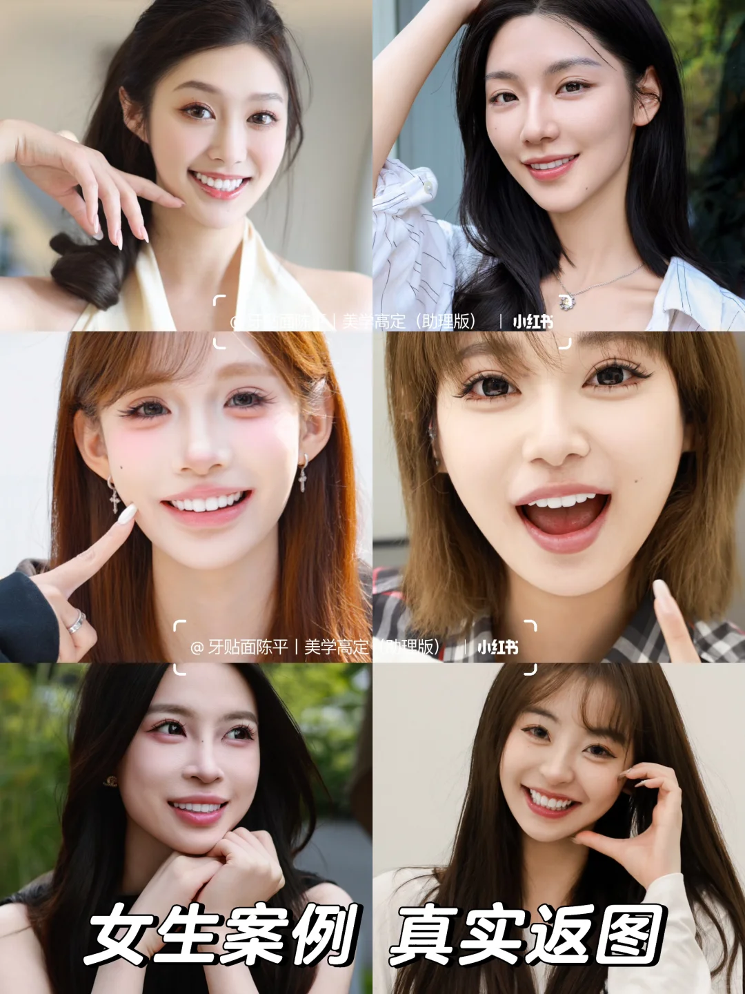 牙贴面｜一篇看懂不同价位贴面优缺点