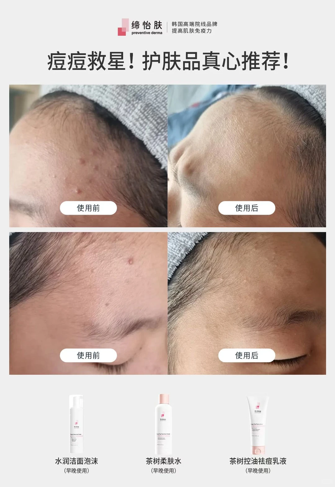 战“痘”成功！这支茶树套装救了我儿子