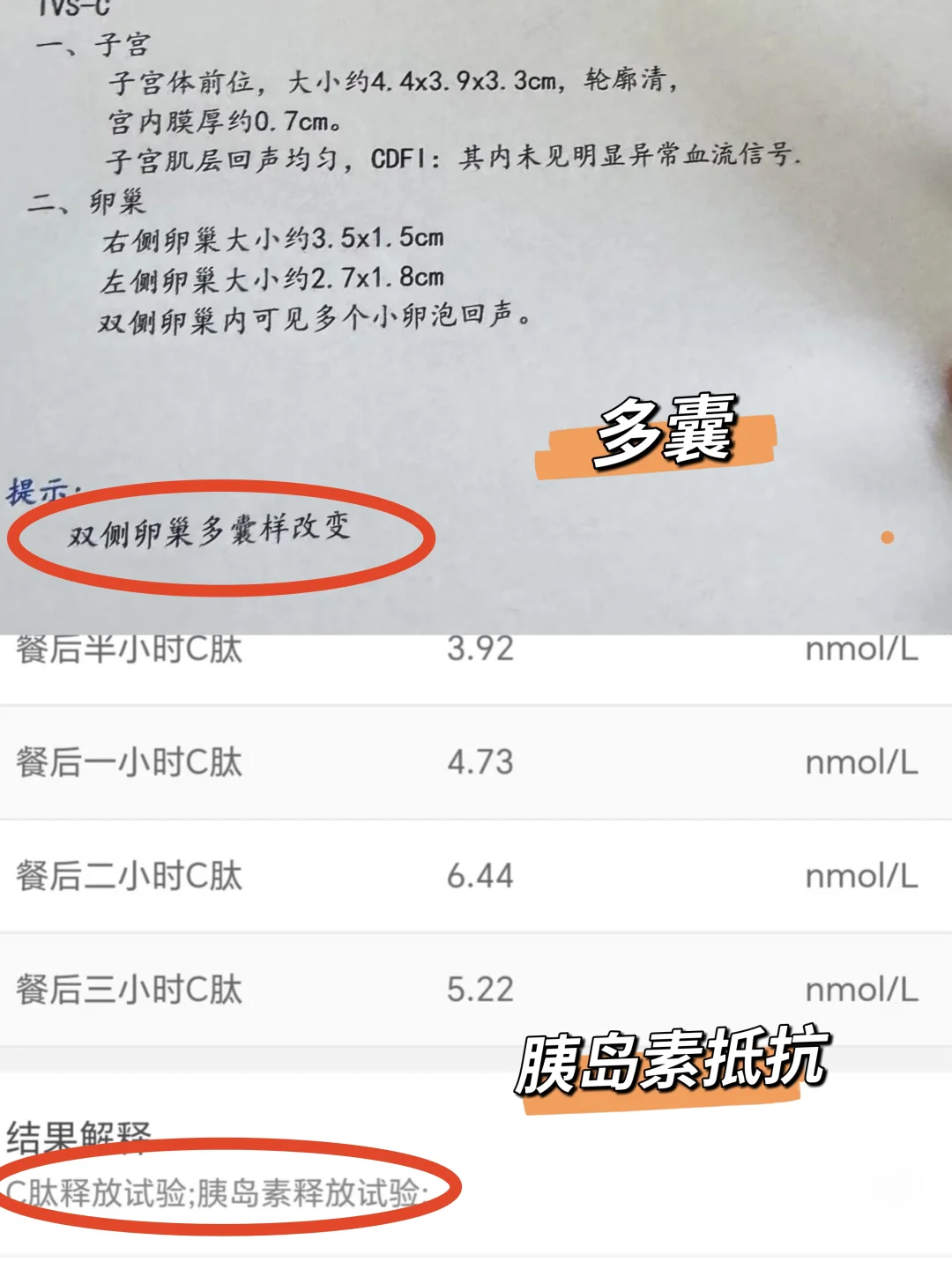 久备不孕的姐妹，都给我去查多囊胰岛素抵抗