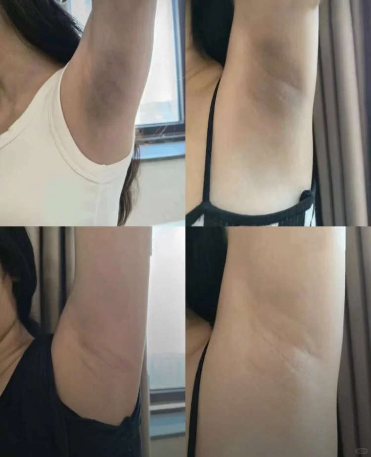 腋下黑抄作业了?摆脱尴尬?实现穿衣自由！
