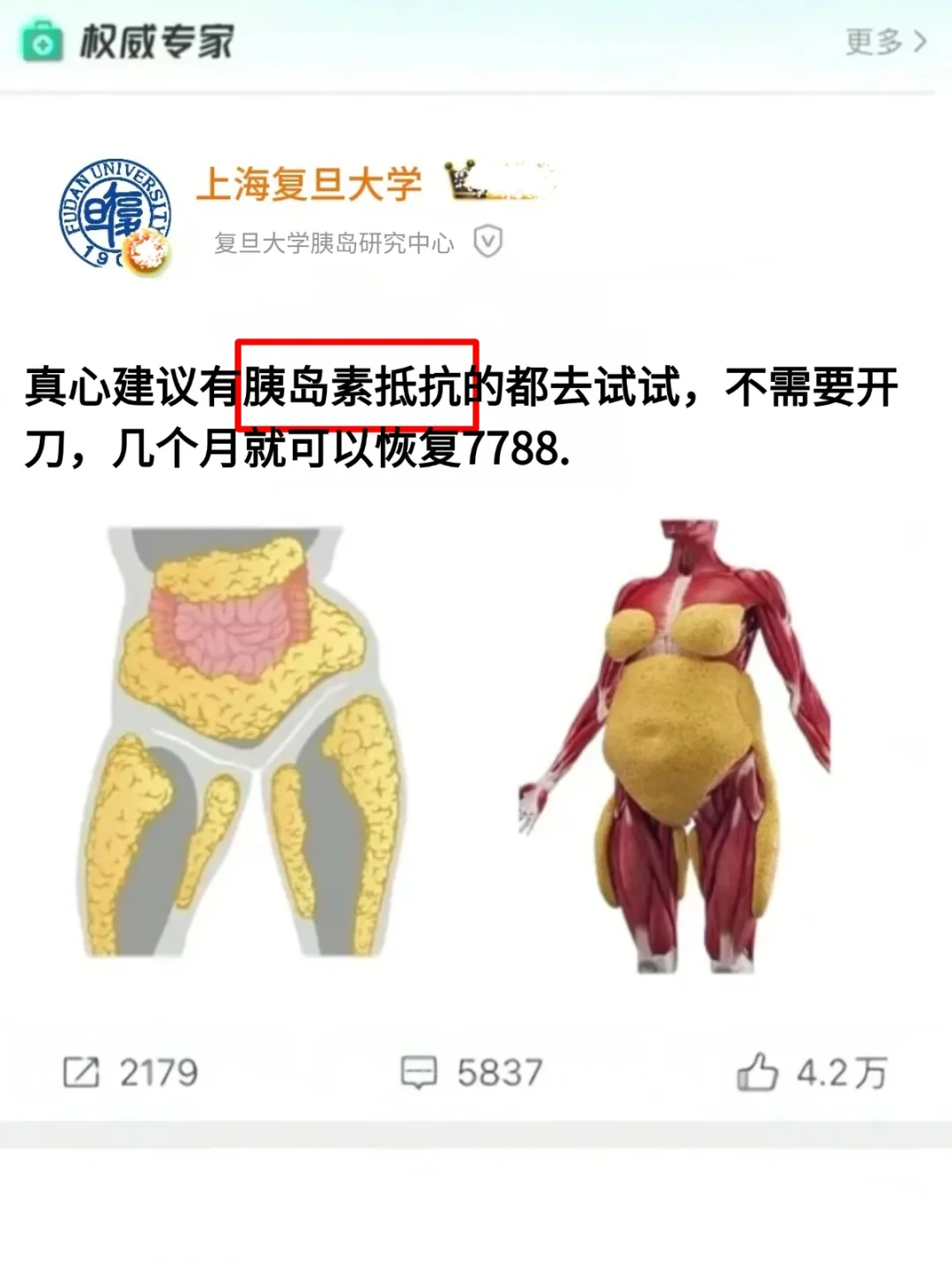 上海复旦大学：胰岛素抵抗好了7788