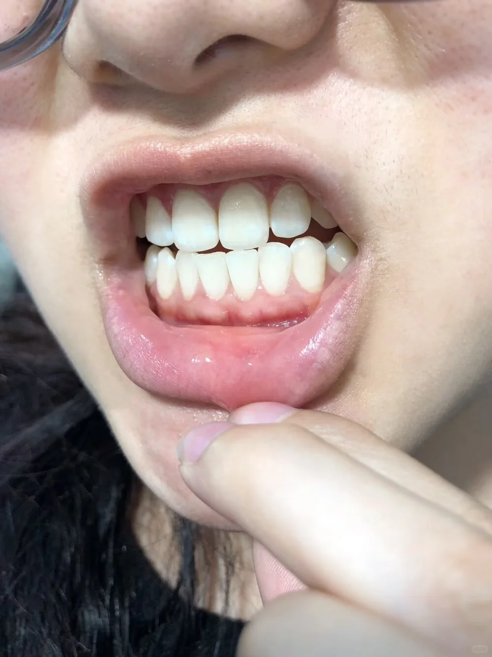 牙周慢慢恢复中