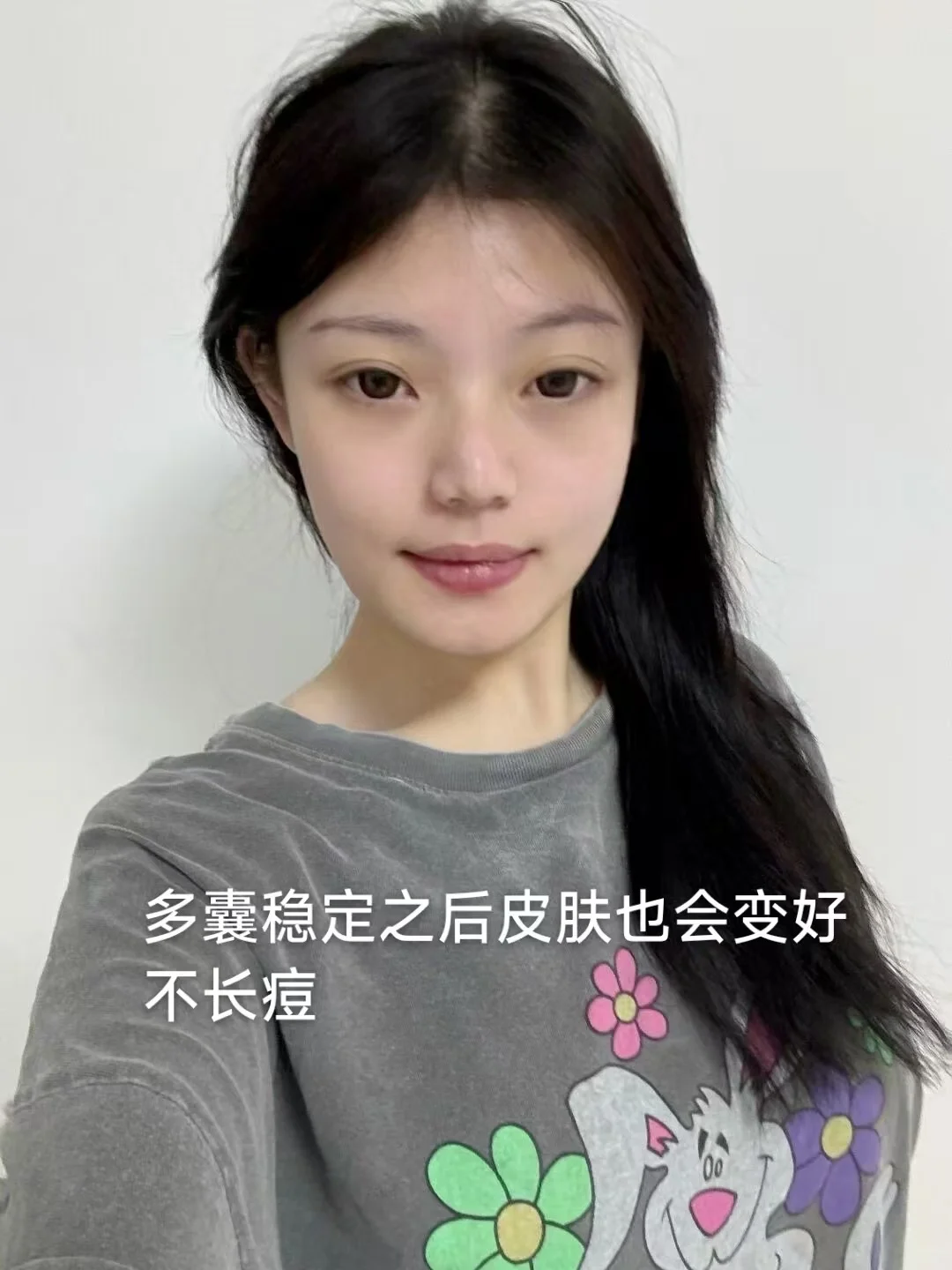 胰岛素抵抗瘦100斤，多囊上岸教程！