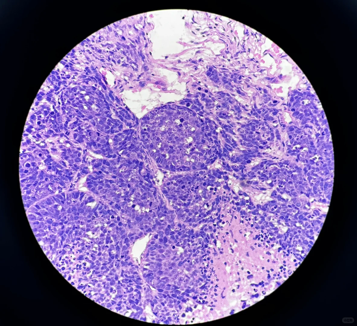 疑似二甲苯中毒