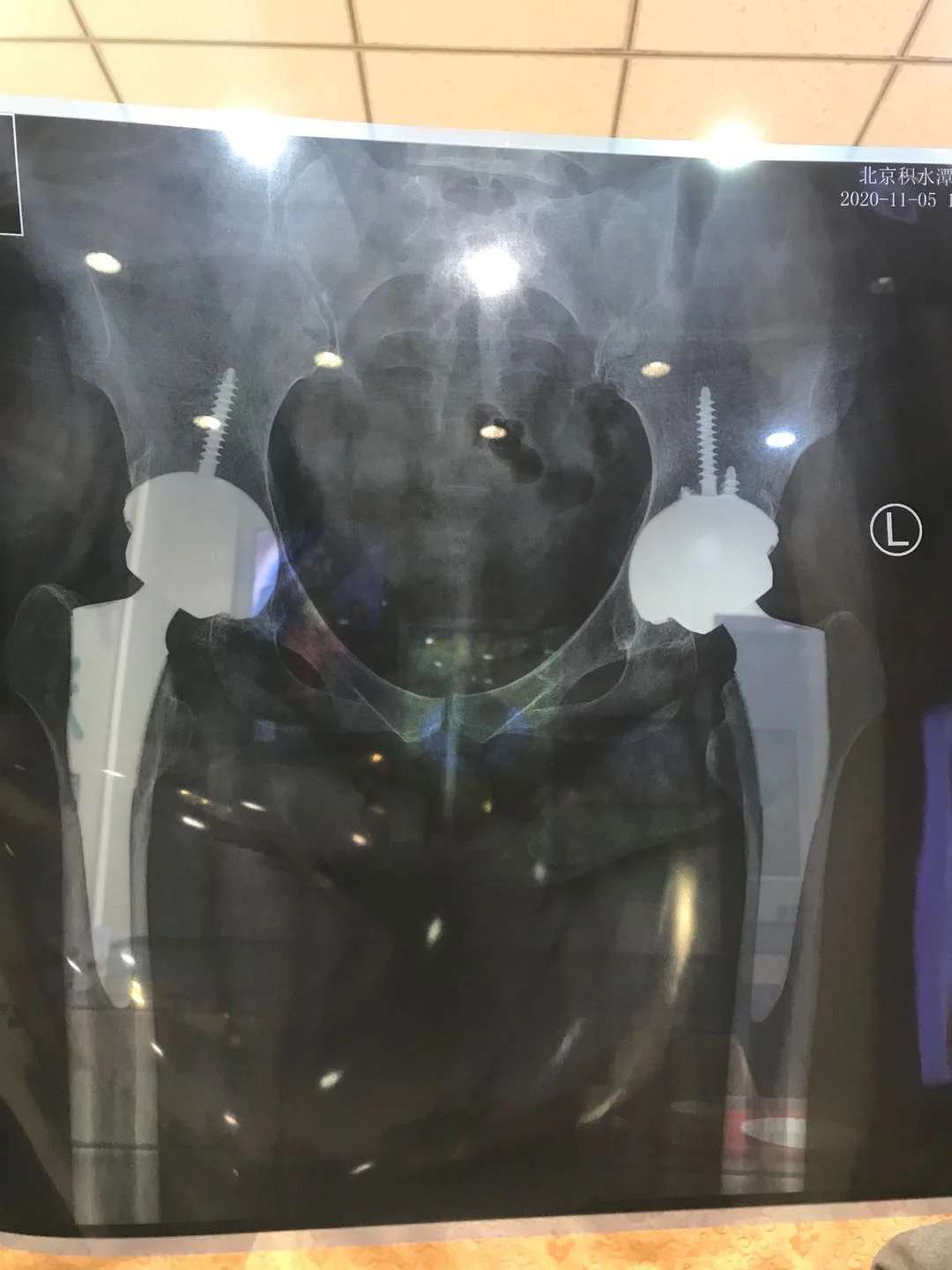 北京积水潭医院关于髋关节置换材料